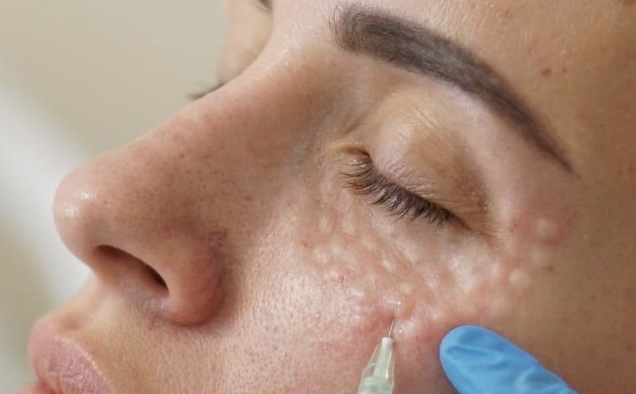 Piel hidratada y luminosa con skinboosters