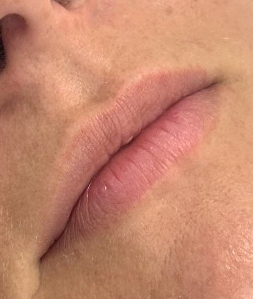 Antes del tratamiento de labios